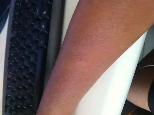 我的胳膊上从昨天开始起皮.越挠越严重.