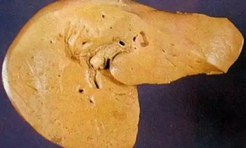 值得收藏|肝纤维化肝硬化成因大揭秘