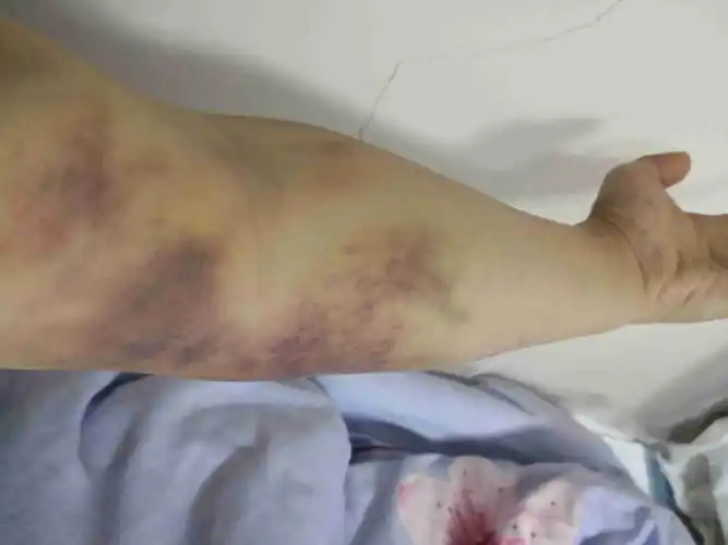 体检抽血后手臂出现大面积瘀血?