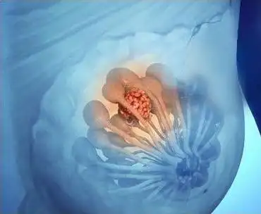 乳腺纤维腺瘤,知道这些就够了