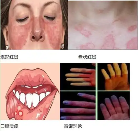 红斑狼疮冲上热搜出现这几个症状要当心