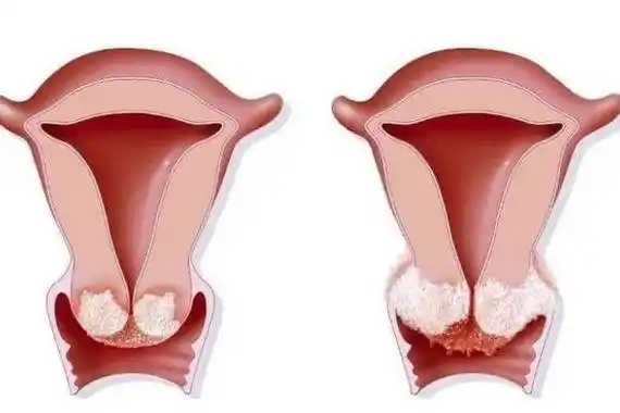 宫颈糜烂有哪些症状?影响试管移植吗?_治疗_成功率_分泌物