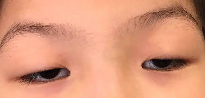 孩子上眼睑下垂什么时候手术合适