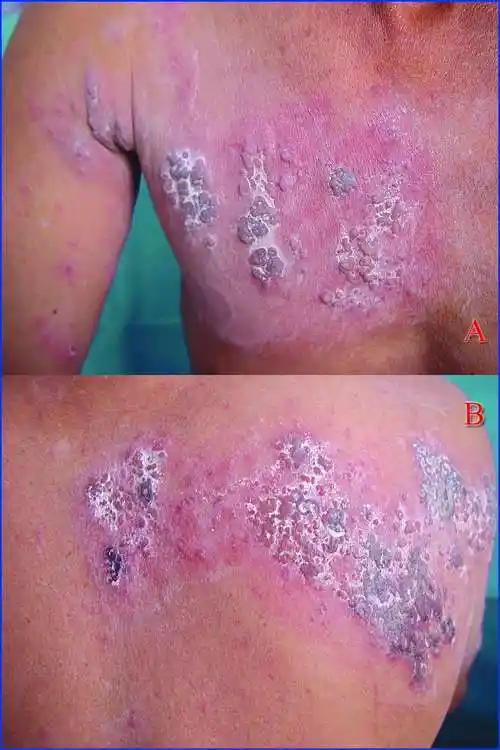 缠腰龙秋天缠上年轻人 - 好大夫在线