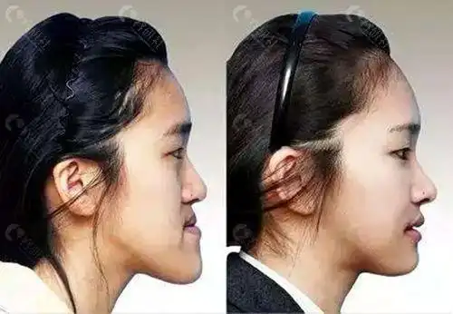 地包天什么时候治疗好牙齿地包天不治有什么影响和危害