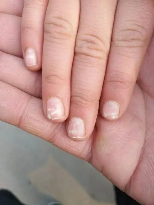 小孩指甲上好多白点,头发也化验了,微量元素也查了,还是有,这是怎