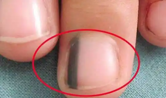手指甲上也能出现癌变,手部出现异常,就一定是黑色素瘤吗指甲上有黑线