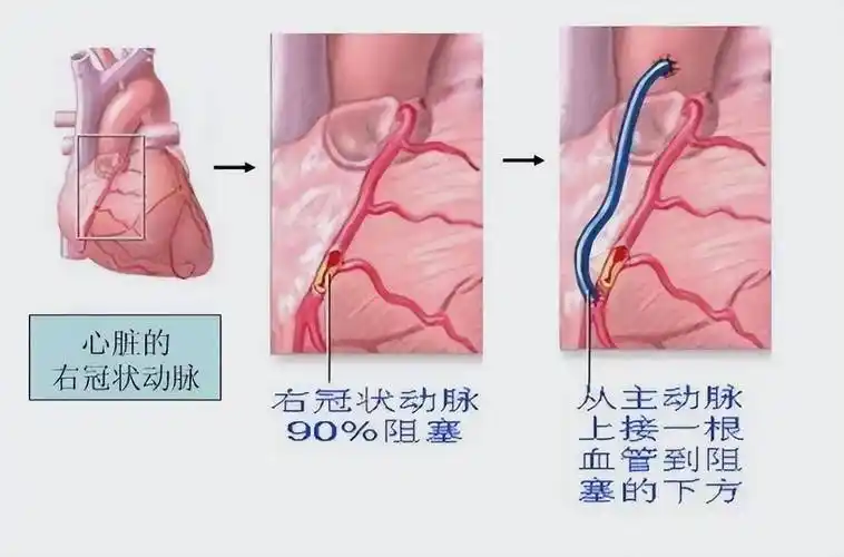 做了心脏搭桥手术,还能活多少年?