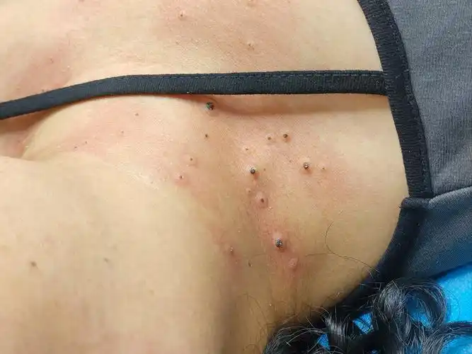 我之前每年都在医院做激光和冷冻,没少花钱更没少遭罪!