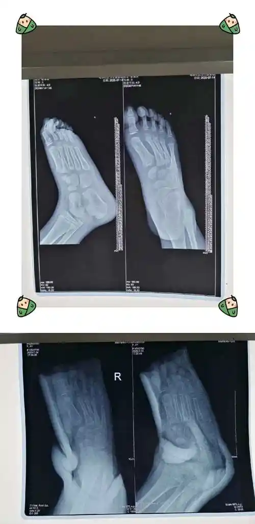 你应该首先注意一下跖骨疼痛部位位于是否第一跖趾关节,也要注意一下