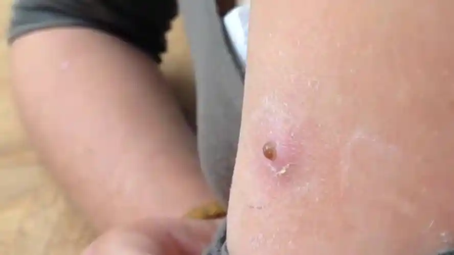 身上真的会长蛆!知道蛆虫哪来的吗?看完保证你不再"躺平"!