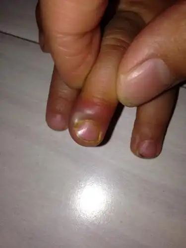 我家宝宝十个月,手指怎么回事?现在不敢动,还红肿!怎么办?