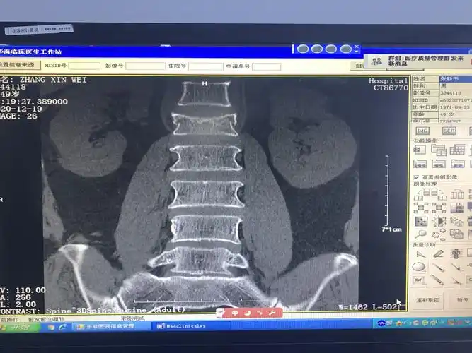 38床, 腰1椎体压缩性骨折