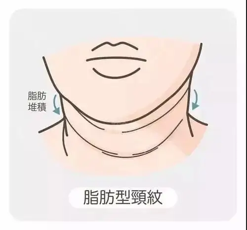 所以脖子不仅容易衰老更容易堆积脂肪