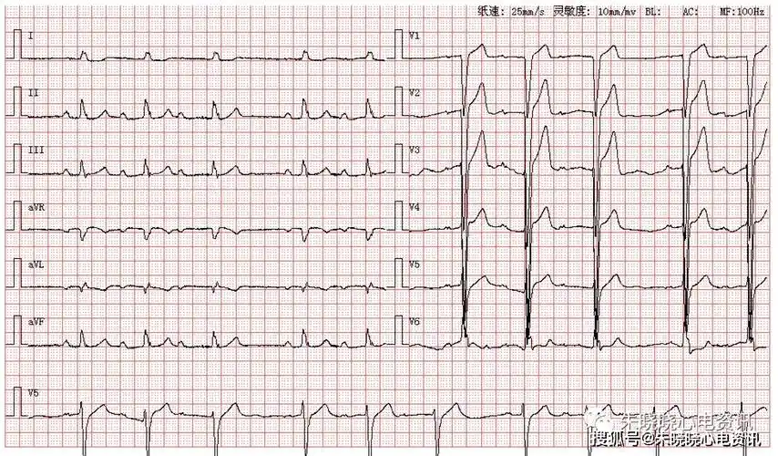 每日读图第1215期二度一型房室传导阻滞不定型室内传导阻滞