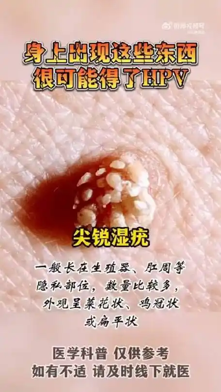 身体上有这几个症状,很有可能得了hpv