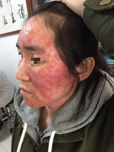 重要严重青春痘治愈验案附图及验方