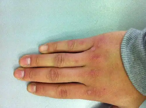 有图,手上有许多硬皮状疙瘩,是什么病?