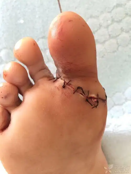 【讨论】足踇趾完全离断再植 [精华] [病例帖]