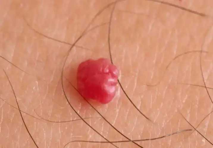 而尖锐湿疣前期并无明显表现,但随着hpv发展,开始生长,呈现"菜花状肉