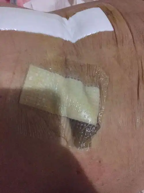 我母亲胃癌做完手术已经出院,今天去换药拔了腹腔引流管