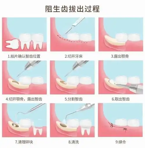 智齿出现这几种情况,疼不疼都得拔!否则