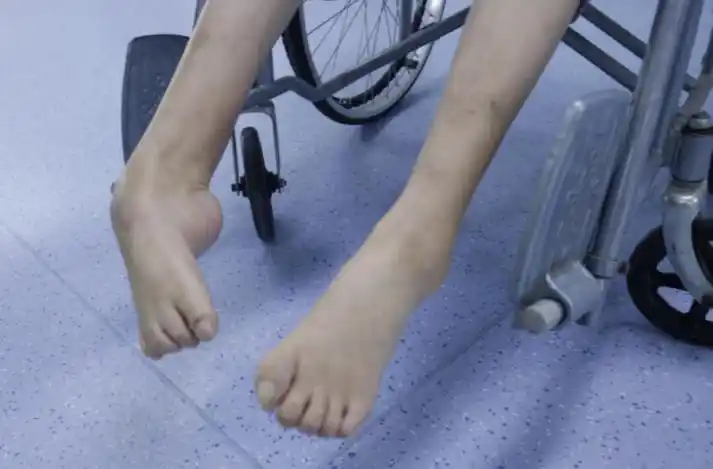 40年"马蹄足"苦不堪言,矫形手术让她启步新生活