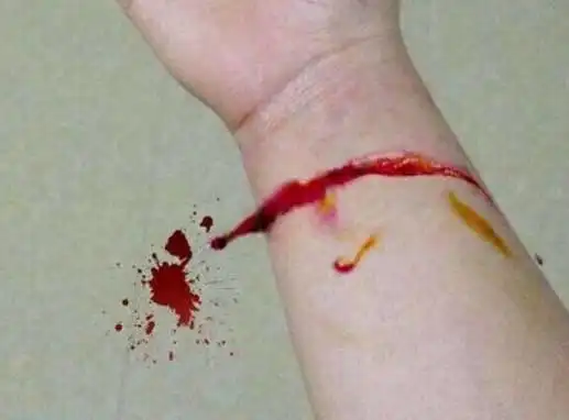 浅层是皮肤和皮下的脂肪组织,下面是腕部的肌腱,血管,神经等