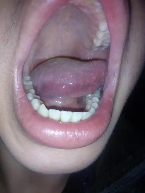 舌头边缘怎么会是这样?有疙瘩