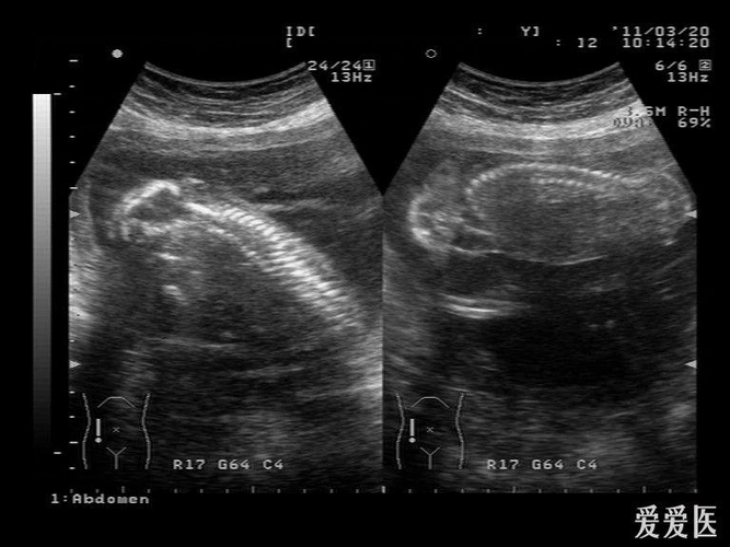 一无脑儿b超图片