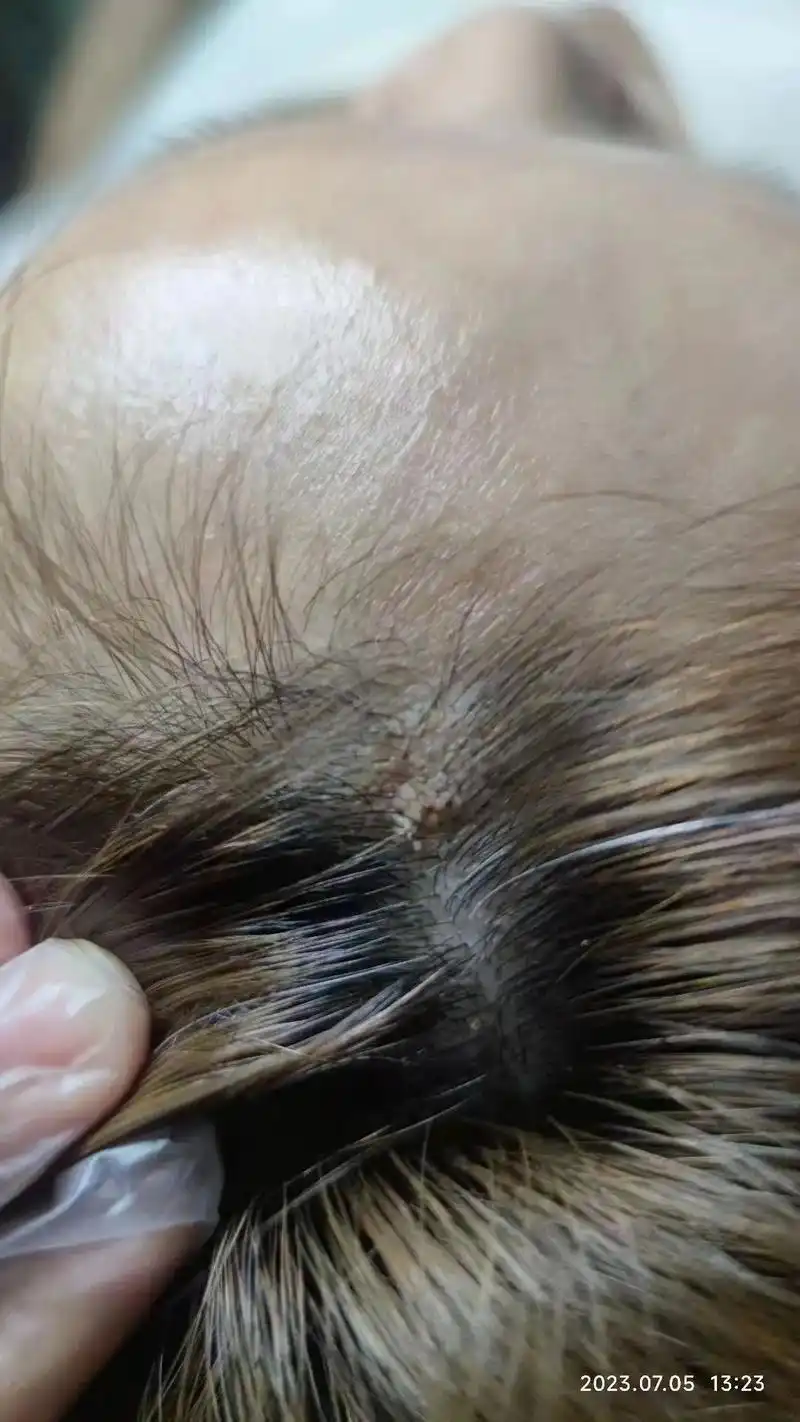 你是否也有此困扰99 疣是由人乳头瘤病毒感染引起97  疣 - 抖音