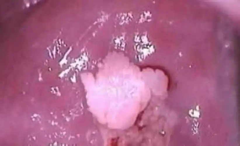 假尖锐湿疣白醋测试图片_有来医生