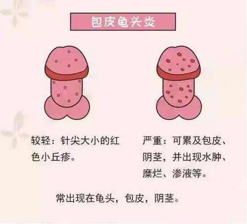 治疗方法是不一样的,龟头炎分为急性浅表性龟头炎,环状溃烂性龟头炎