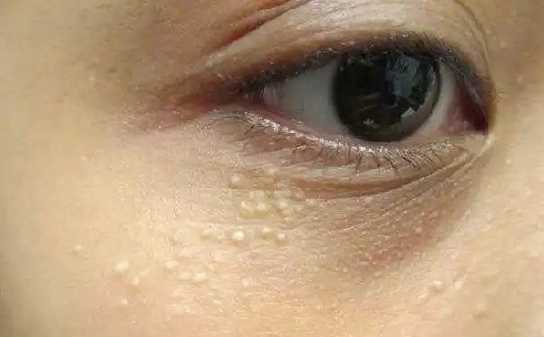 女性如何预防脸上长脂肪粒?女性脸色长了脂肪粒该怎么办?(1)