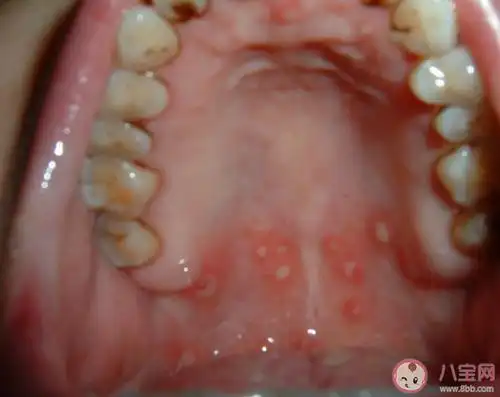 复发性口腔溃疡有办法根治吗多久没愈合要看医生