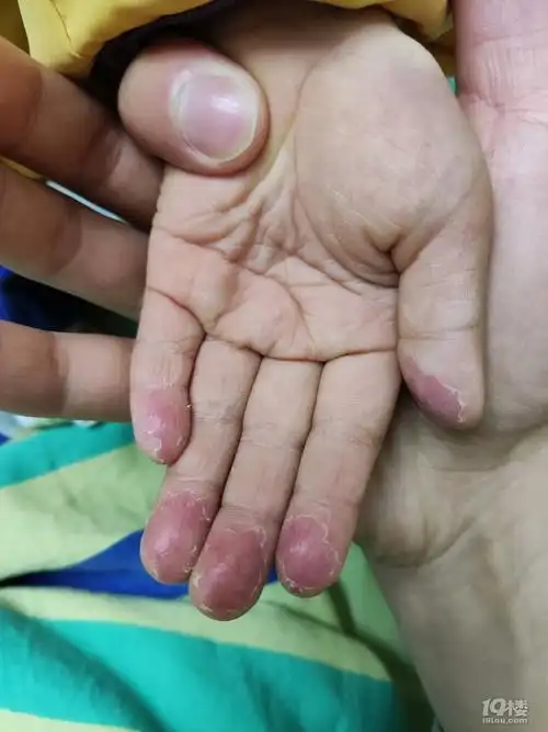 家里小孩十个手指头都脱皮是怎么回事