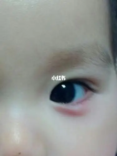 孩61的子69下眼睑颜色不正常7167600566有淡红,淡青