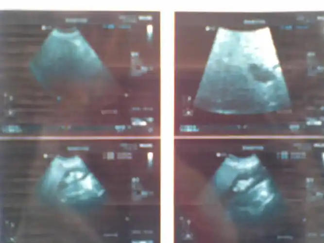 p>多发型 a href="#" data-lemmaid="771825">胆结石 /a>的诊断一般