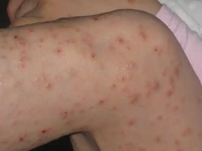 女孩你受罪了,有人见过这样的疮吗?