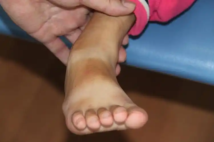 油尖旺区足外翻专家_油尖旺区治疗足外翻哪个专家好_油尖旺区治疗足