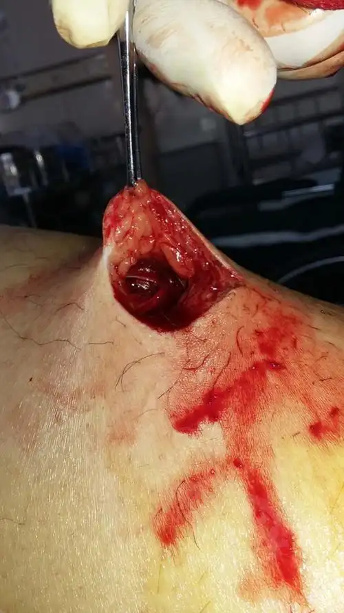 腿部刀伤几天后可以跑步,深达5厘米到肌肉,最近有5公里考核,不知道得