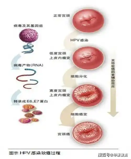 2020年7月30日,美国癌症学会(asc)制定了最新版宫颈癌筛查指南,对比上