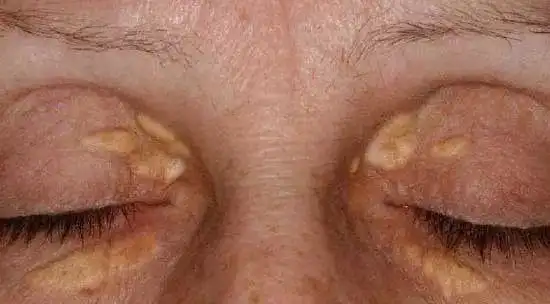 眼睛出现3种症状,或说明血脂高了