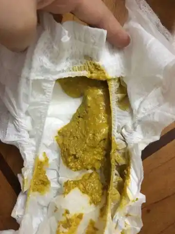 宝宝的便便一直是有点糊状,是否是消化不良的症状.