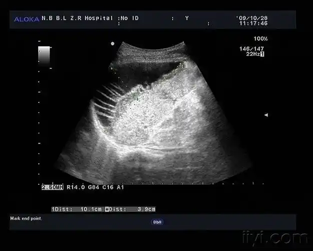 脾破裂(脾内血肿),脾周血肿