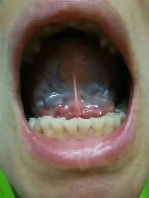 舌下放血疗法,神医天啦撸!