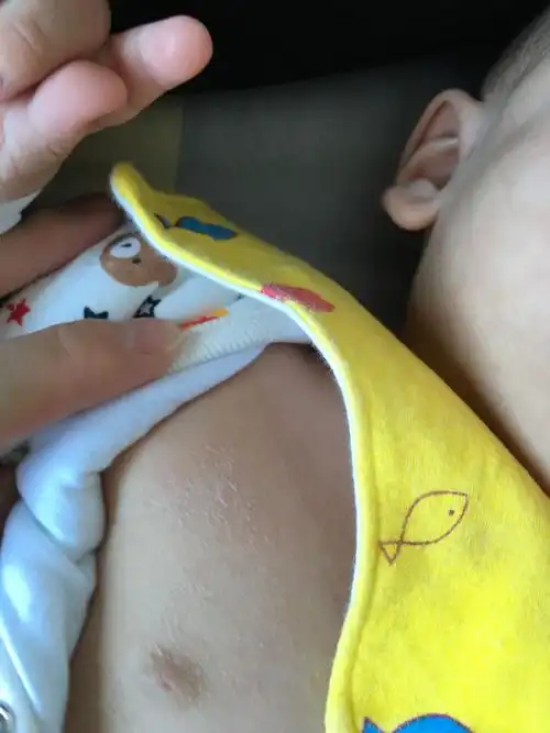 8个月宝宝身上干燥,还有这种鸡皮疙瘩怎么回事啊