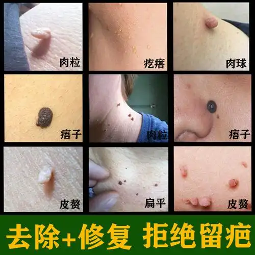 鸦胆子祛疣膏腋下丝状疣脖子去除神器颈部点疣瘊肉粒一抹无忧药水