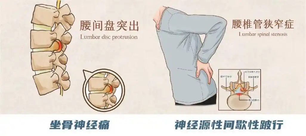从而导致的一系列腰椎神经压迫引起的症状,统称为腰椎管狭窄症