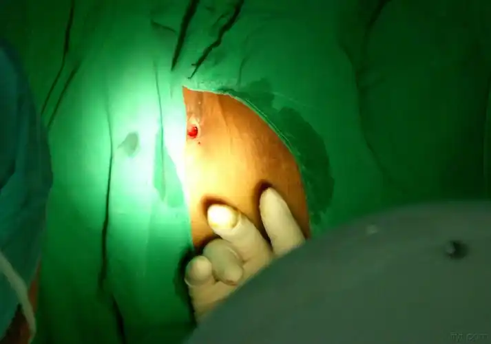 诊断不明确的"肛瘘".非常少见.